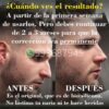 Rinoplastia Natural - Imagen 3